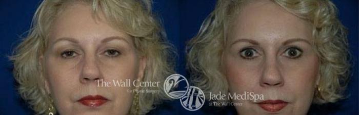 Before & After Eyelid Surgery Case 186 View #2 View in Shreveport, LA