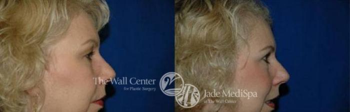 Before & After Eyelid Surgery Case 186 View #3 View in Shreveport, LA