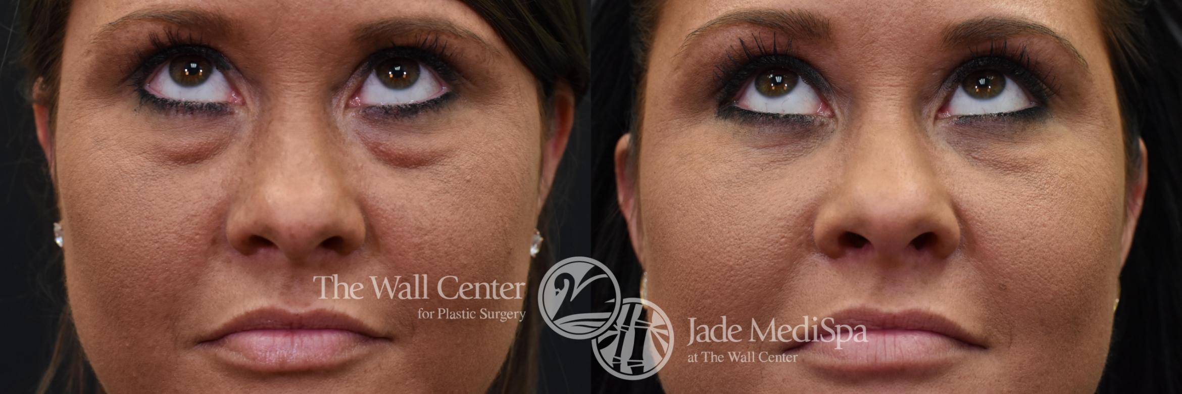 Eyelid Surgery Case 568 Before & After View #1 | Shreveport, LA | The Wall Center