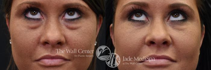 Before & After Eyelid Surgery Case 568 View #1 View in Shreveport, LA