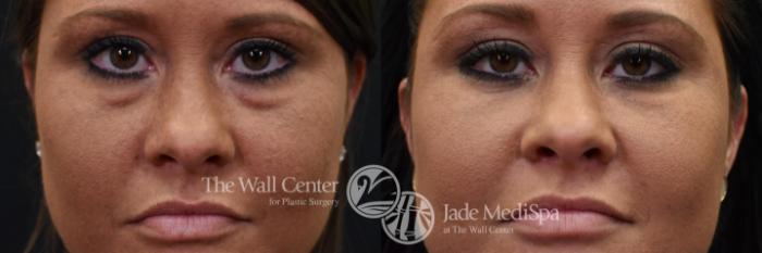 Before & After Eyelid Surgery Case 568 View #2 View in Shreveport, LA