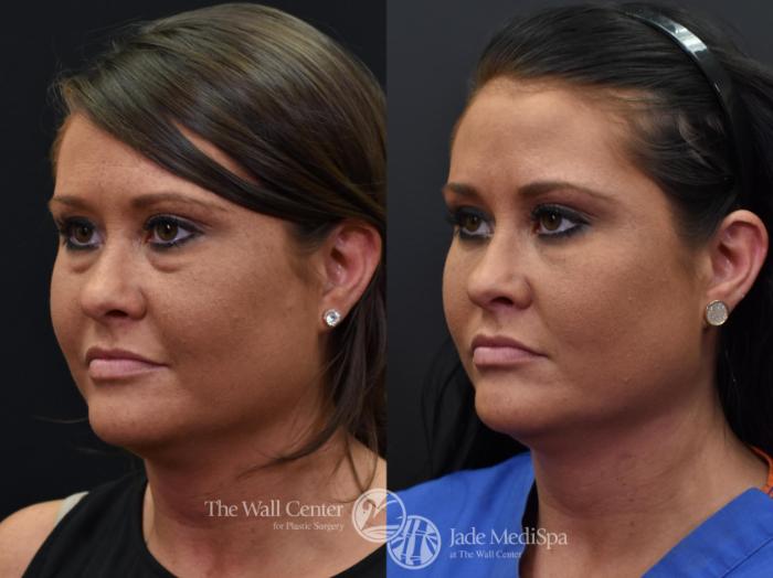 Before & After Eyelid Surgery Case 568 View #3 View in Shreveport, LA