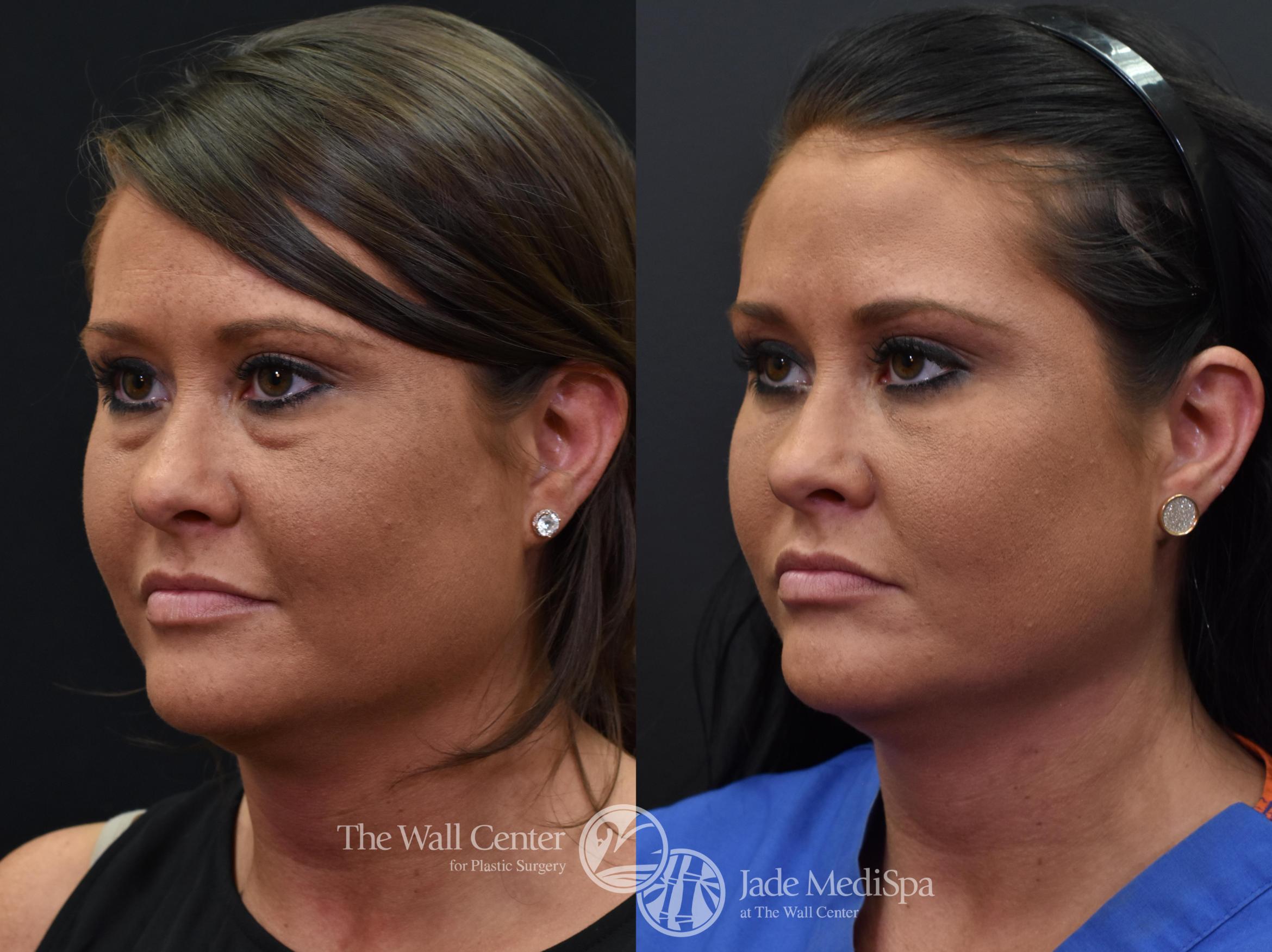 Before & After Eyelid Surgery Case 568 View #4 View in Shreveport, LA