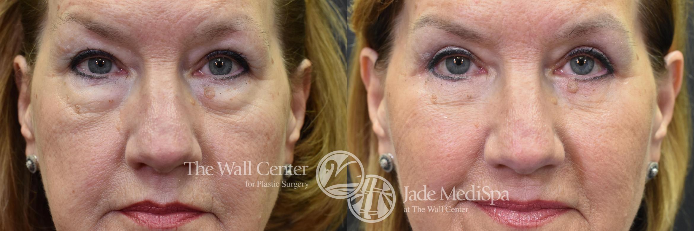 Before & After Eyelid Surgery Case 574 View #1 View in Shreveport, LA