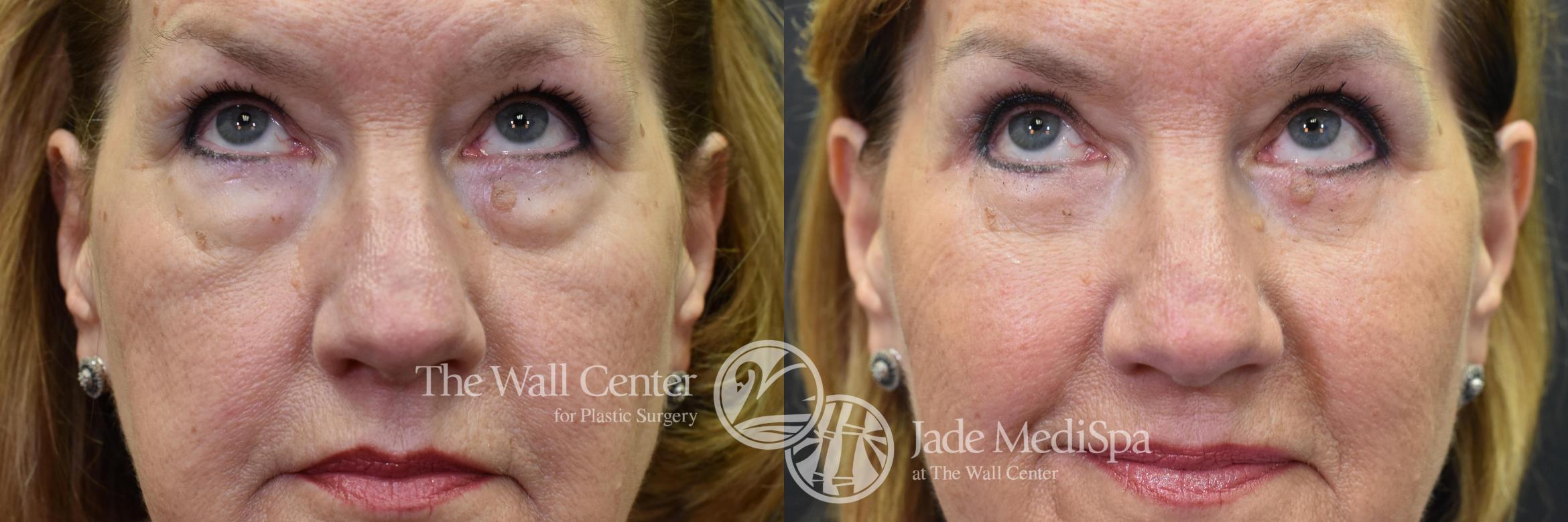 Before & After Eyelid Surgery Case 574 View #2 View in Shreveport, LA