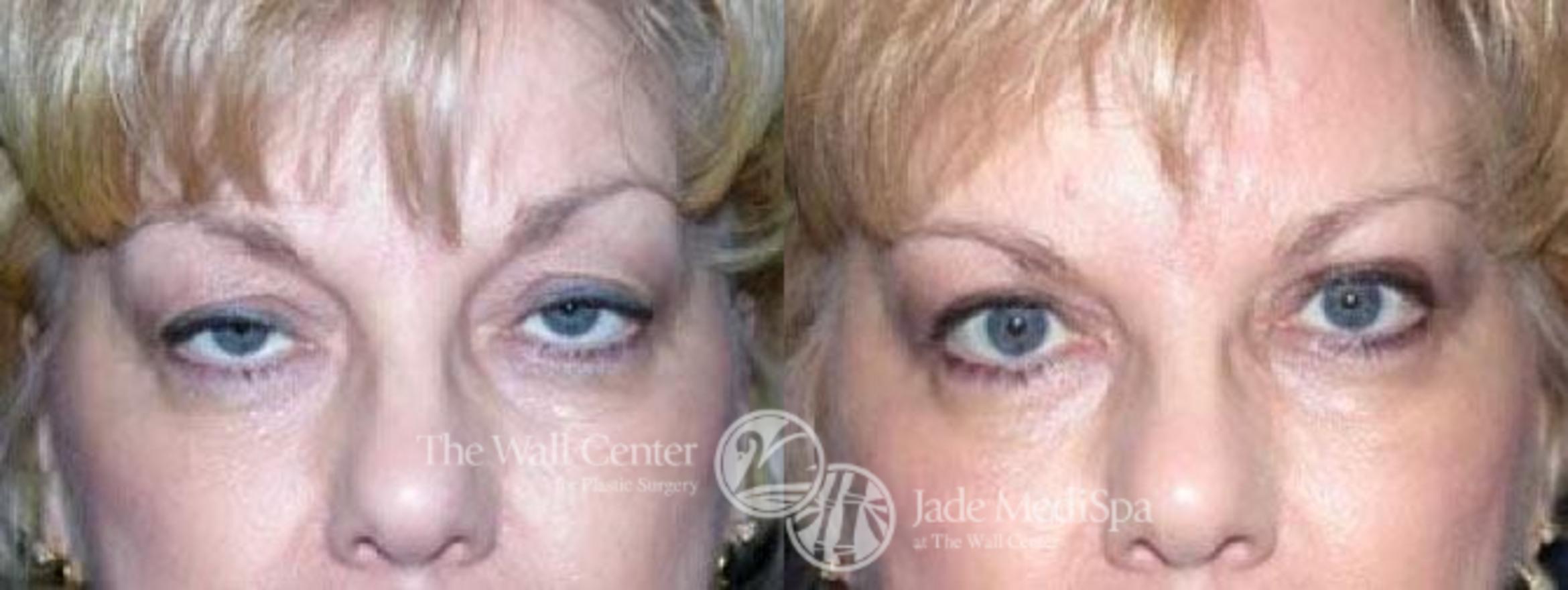 Before & After Eyelid Surgery Case 85 View #1 View in Shreveport, LA