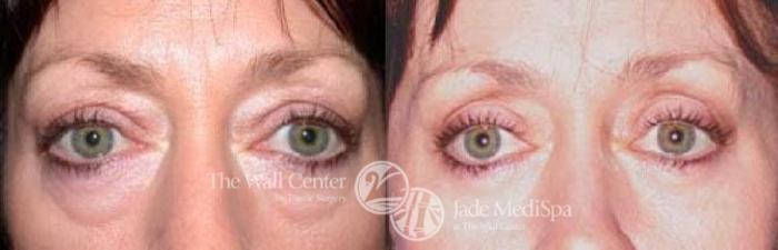 Before & After Eyelid Surgery Case 86 View #1 View in Shreveport, LA