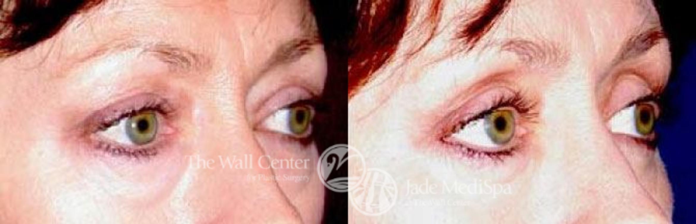 Before & After Eyelid Surgery Case 86 View #2 View in Shreveport, LA