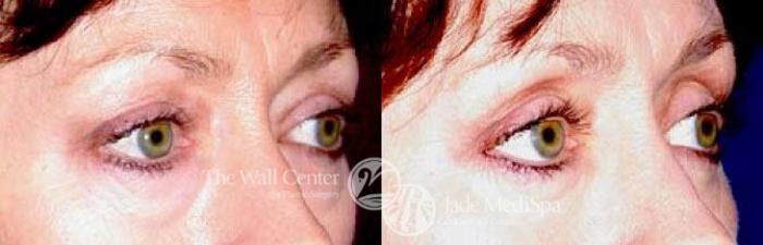 Before & After Eyelid Surgery Case 86 View #2 View in Shreveport, LA