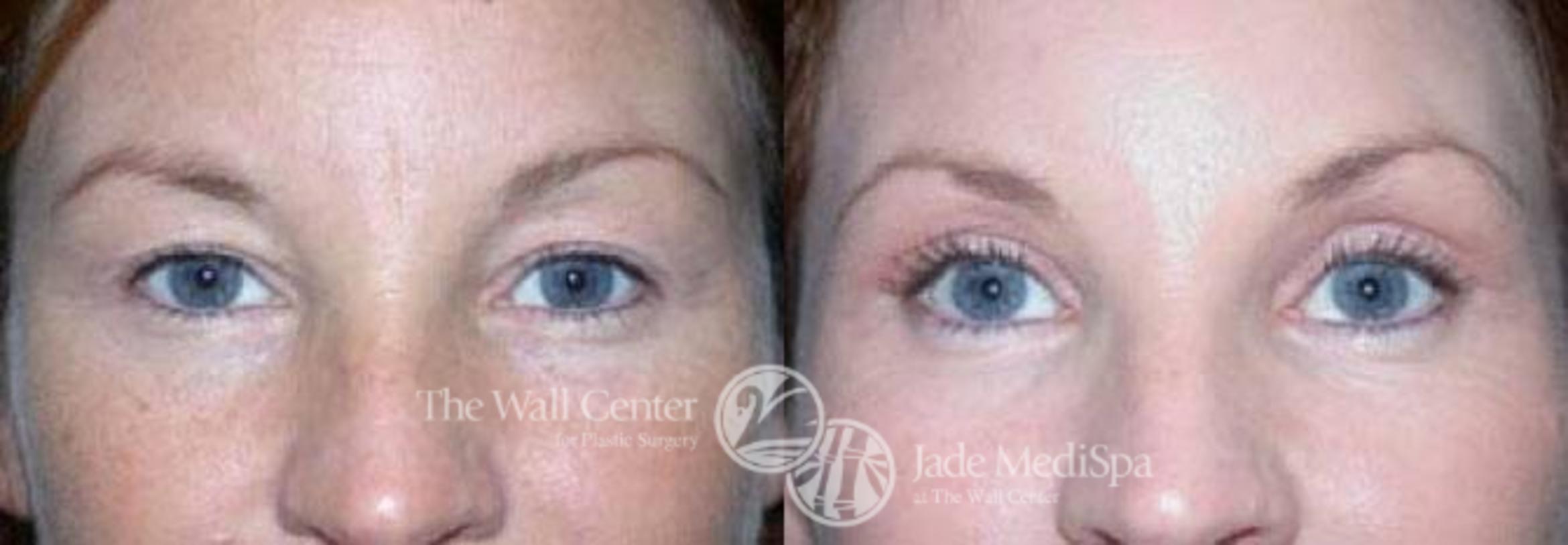 Before & After Eyelid Surgery Case 87 View #1 View in Shreveport, LA