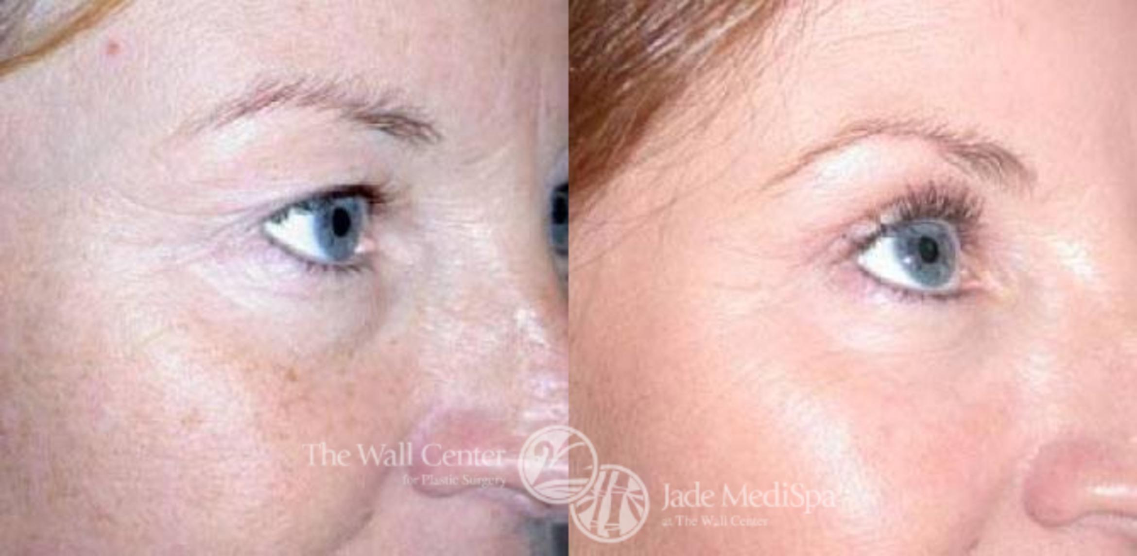 Before & After Eyelid Surgery Case 87 View #2 View in Shreveport, LA