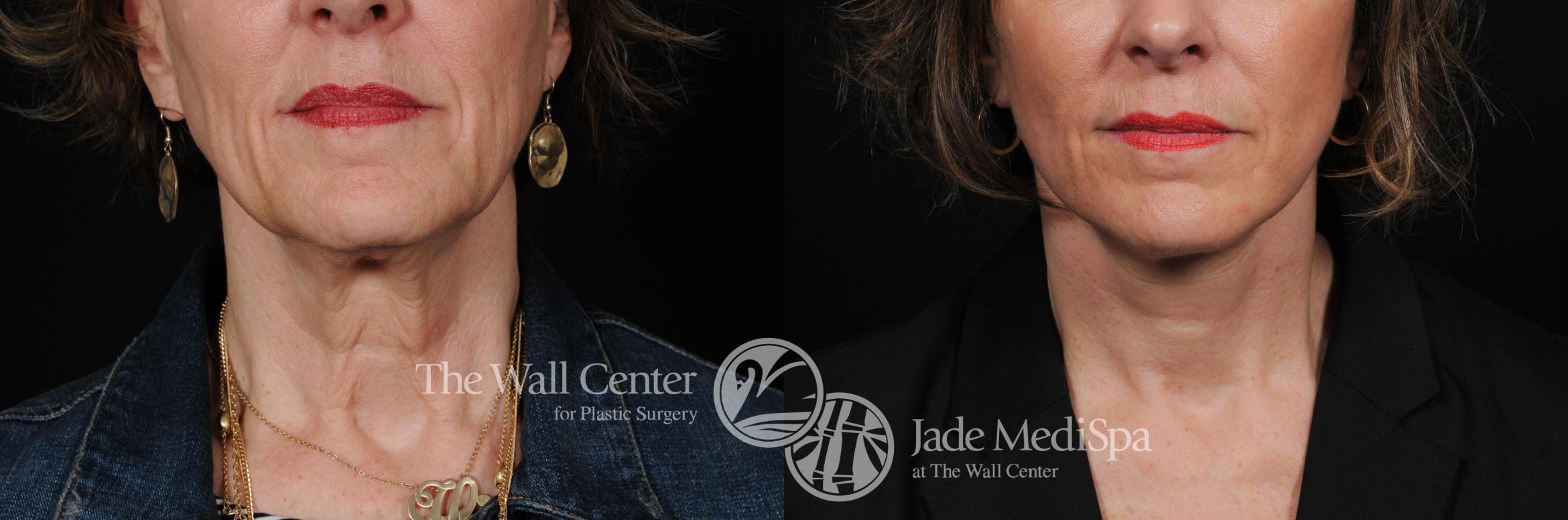 Before & After Cheek/Chin Augmentation Case 355 View #1 View in Shreveport, LA