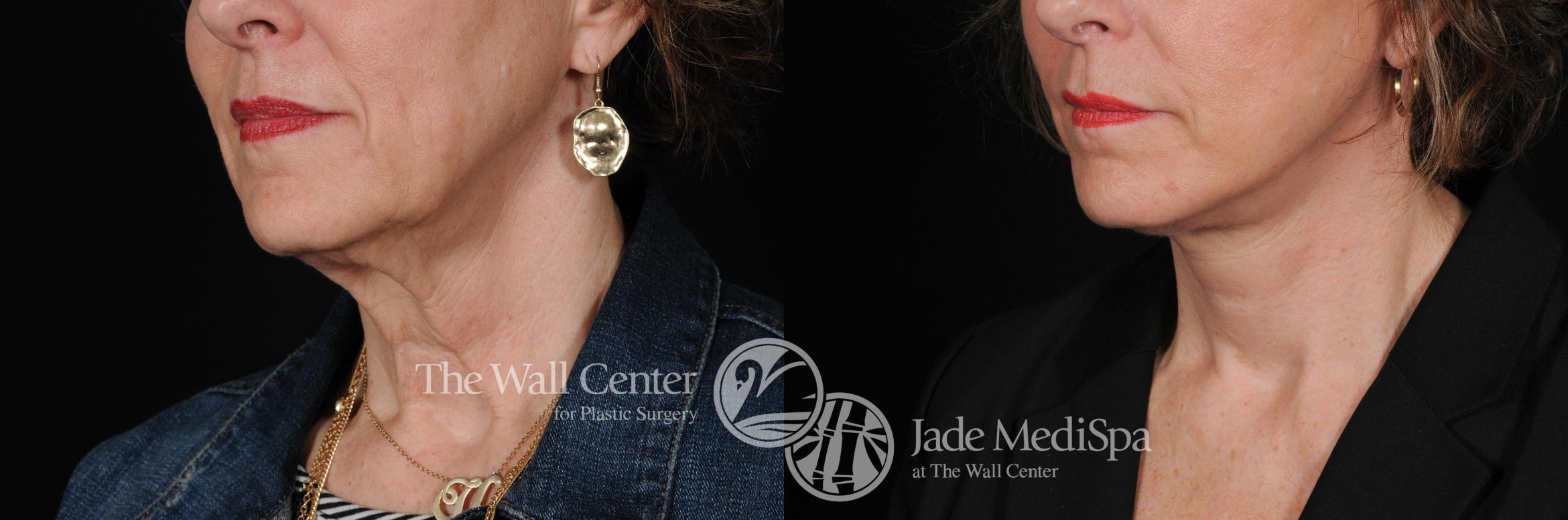 Before & After Facelift Case 355 View #2 View in Shreveport, LA