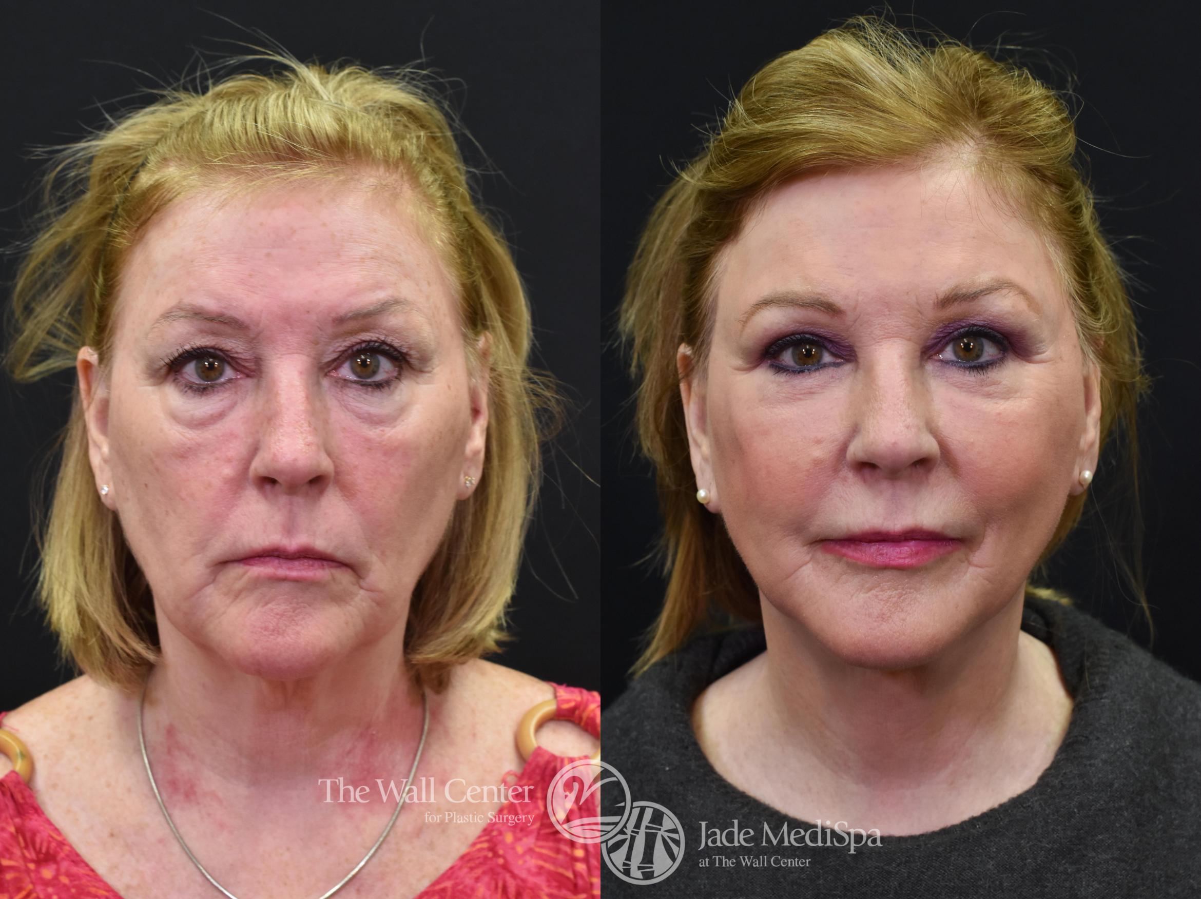 Before & After Fat Grafting – Face Case 579 View #1 View in Shreveport, LA