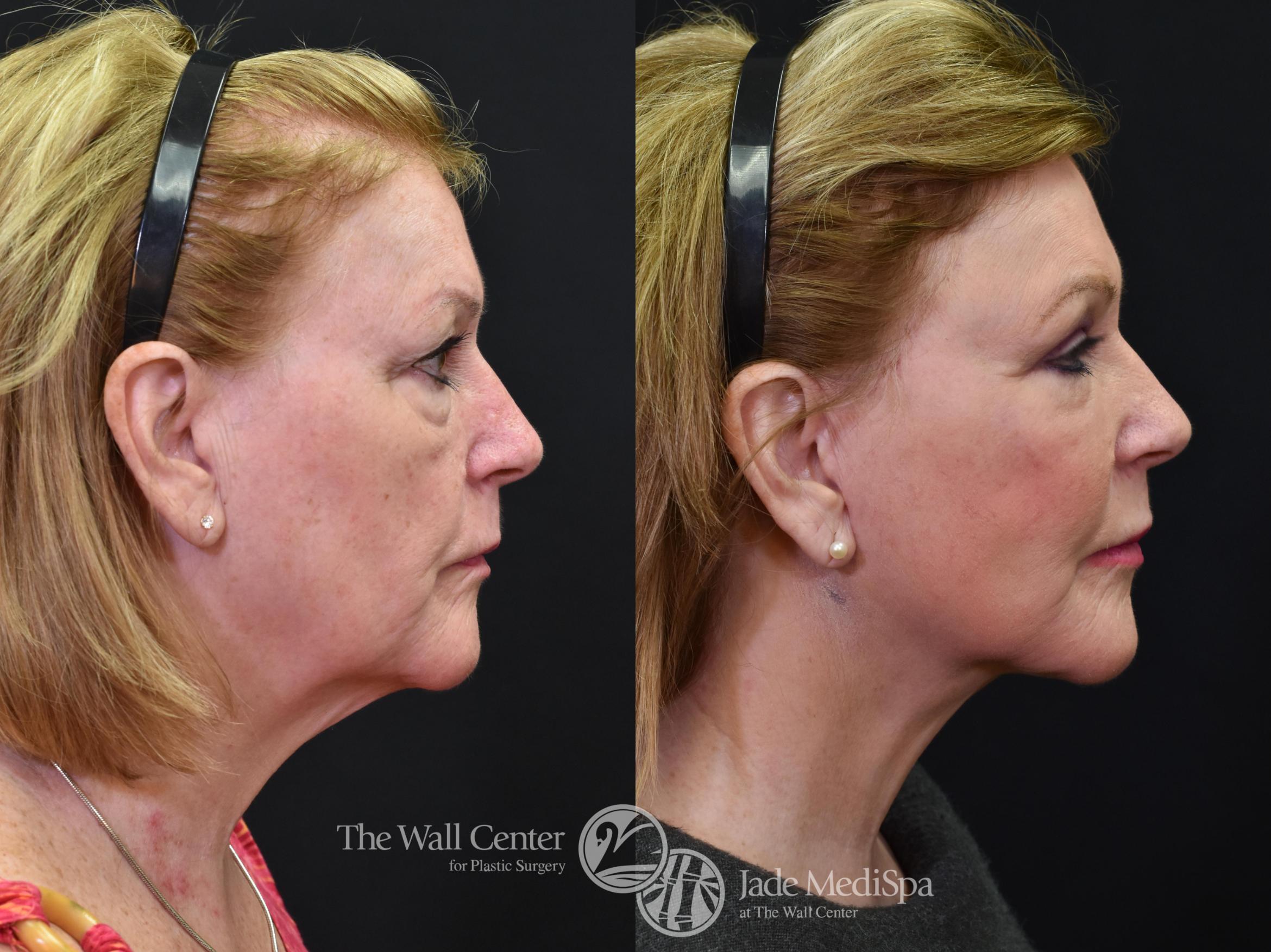 Before & After Fat Grafting – Face Case 579 View #3 View in Shreveport, LA