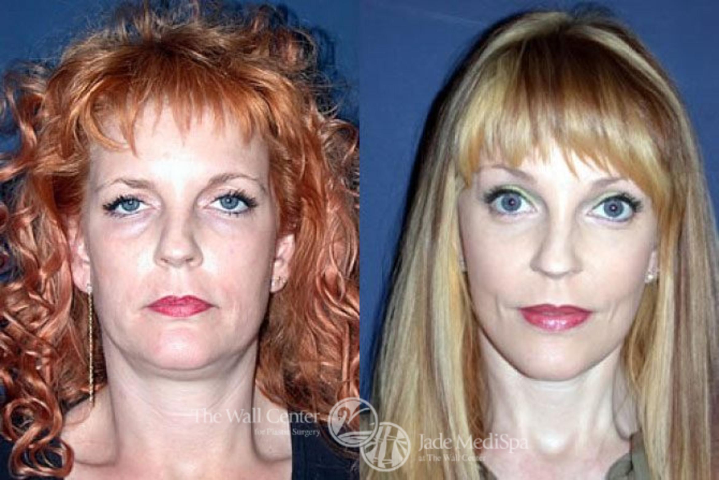 Before & After Face Lift Case 83 View #1 View in Shreveport, LA