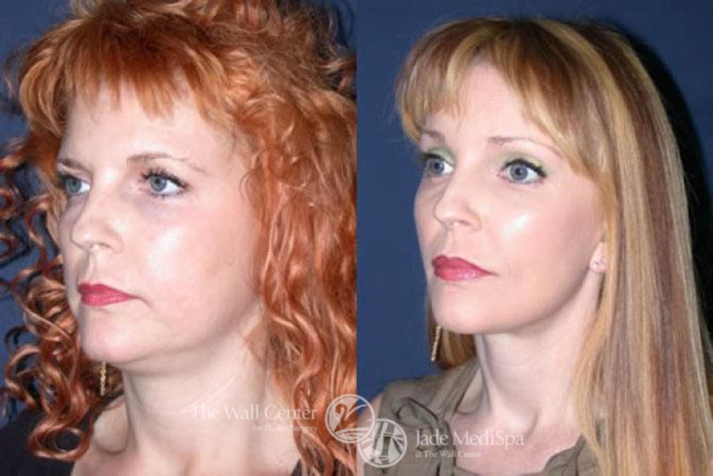 Before & After Lip Augmentation Case 83 View #2 View in Shreveport, LA