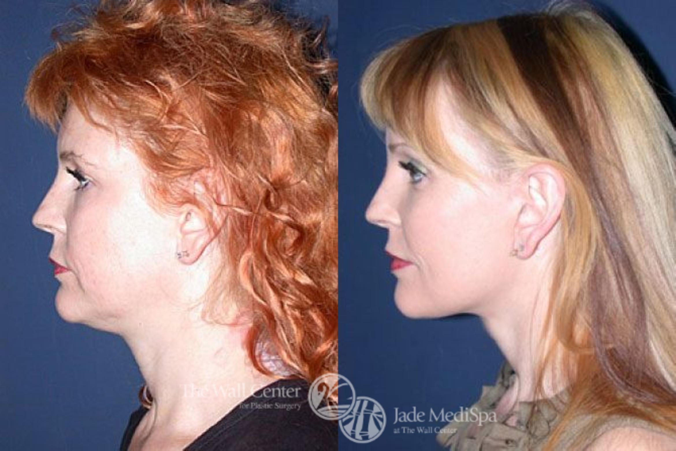 Before & After Lip Augmentation Case 83 View #3 View in Shreveport, LA