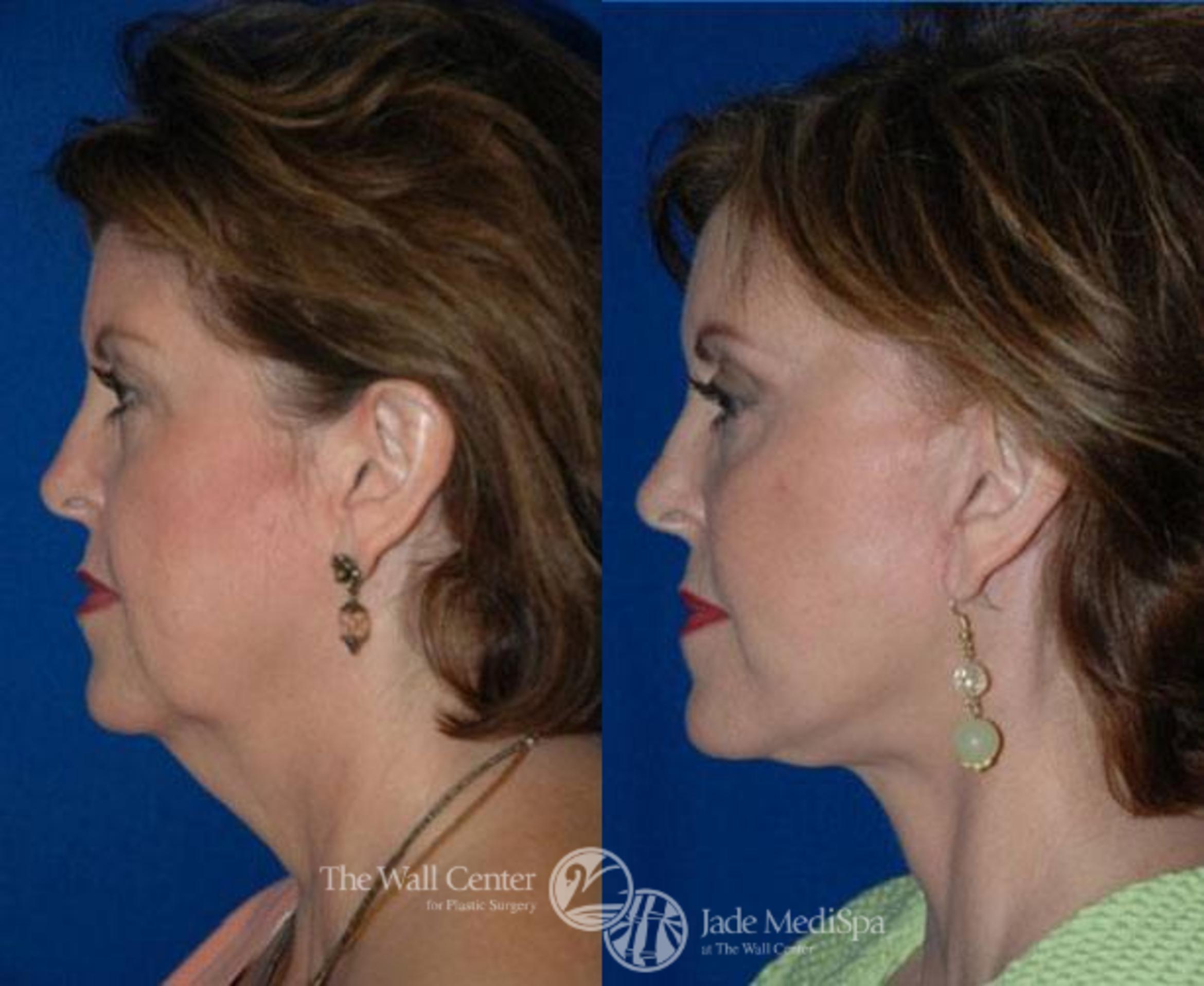 Before & After Face Lift Case 84 View #1 View in Shreveport, LA