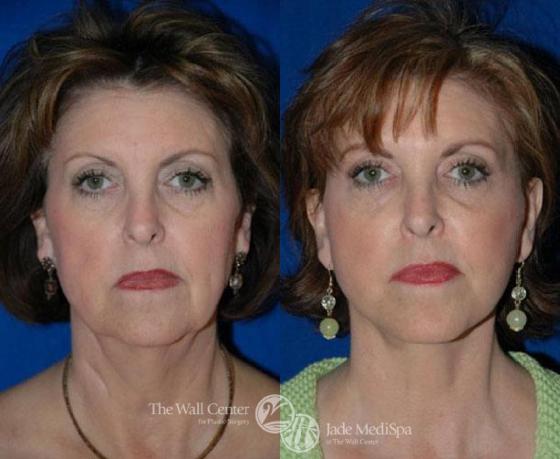 Before & After Double Chin Reduction Case 84 View #2 View in Shreveport, LA