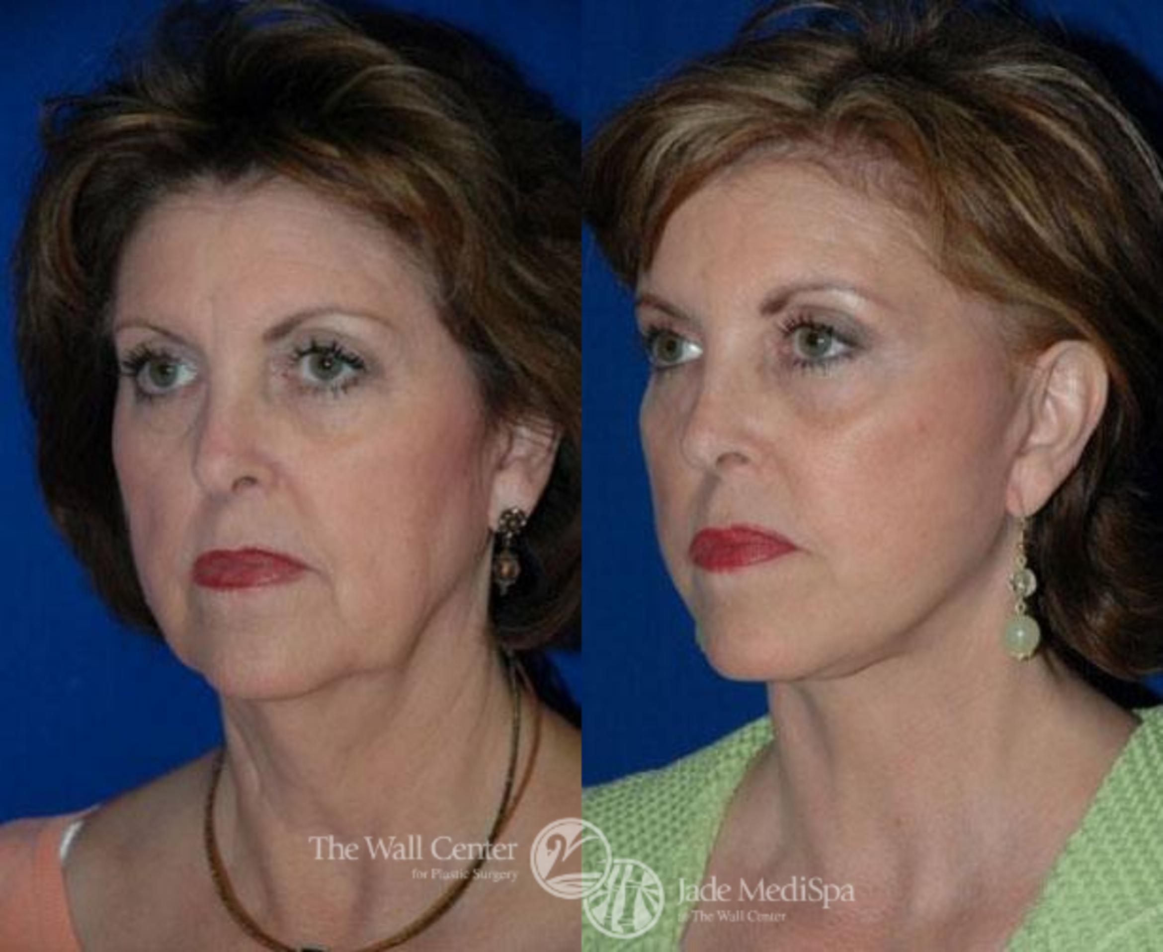 Before & After Double Chin Reduction Case 84 View #3 View in Shreveport, LA