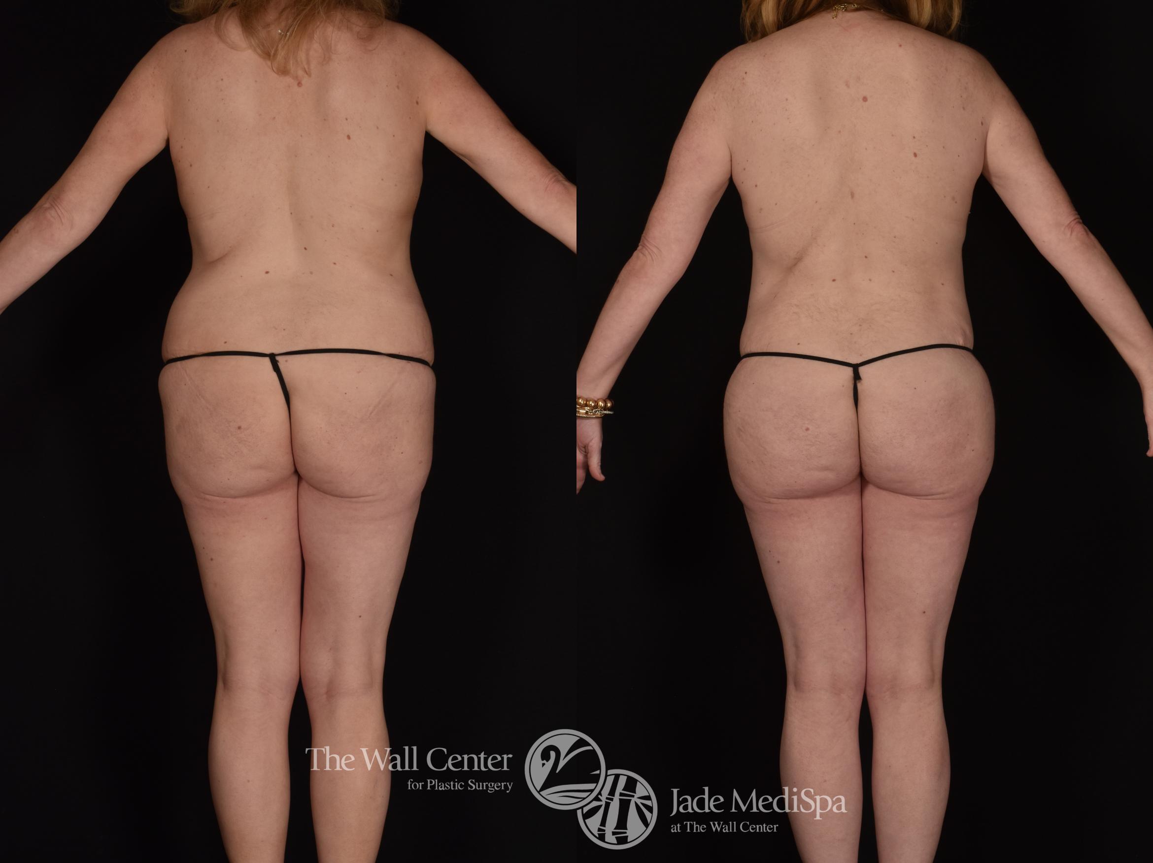 Before & After Buttock Augmentation Case 1014 Back View in Shreveport, LA