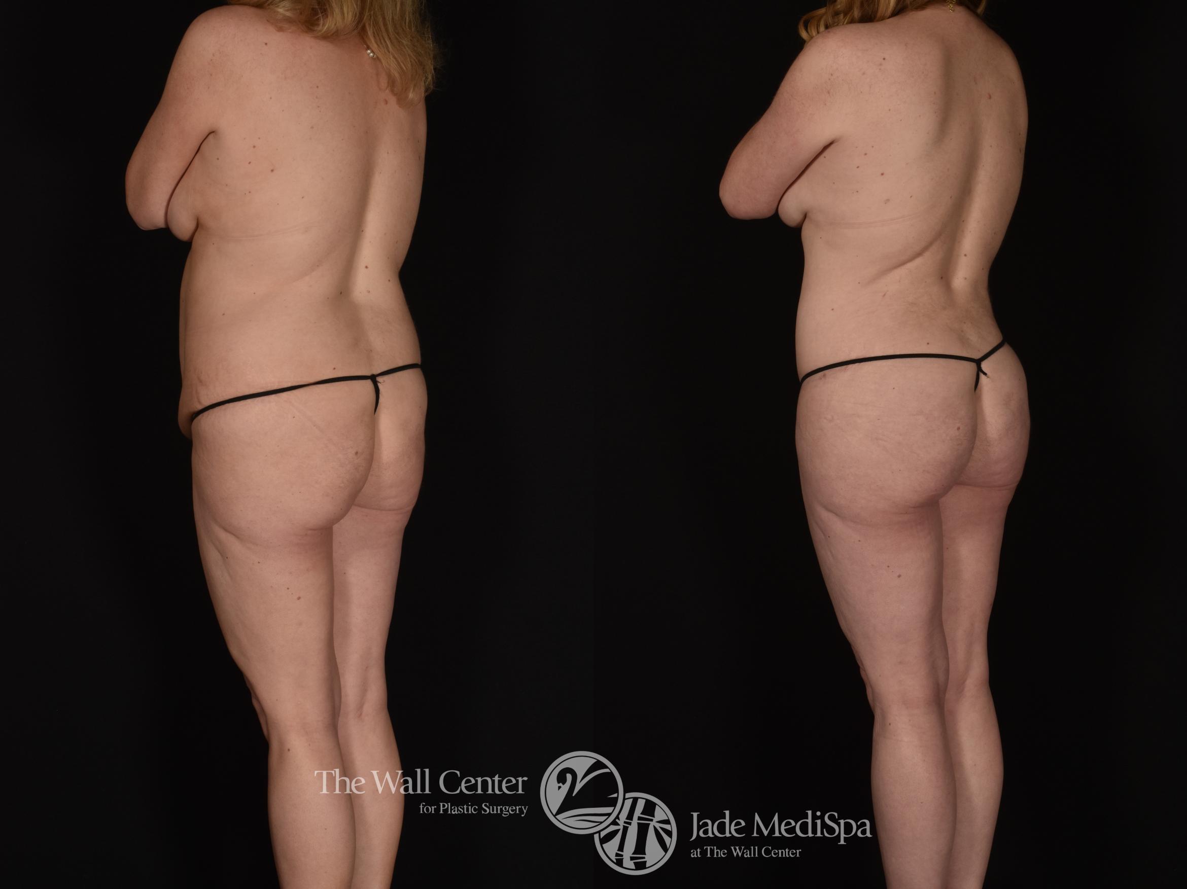 Before & After SAFELipo™ Case 1014 Left Oblique View in Shreveport, LA