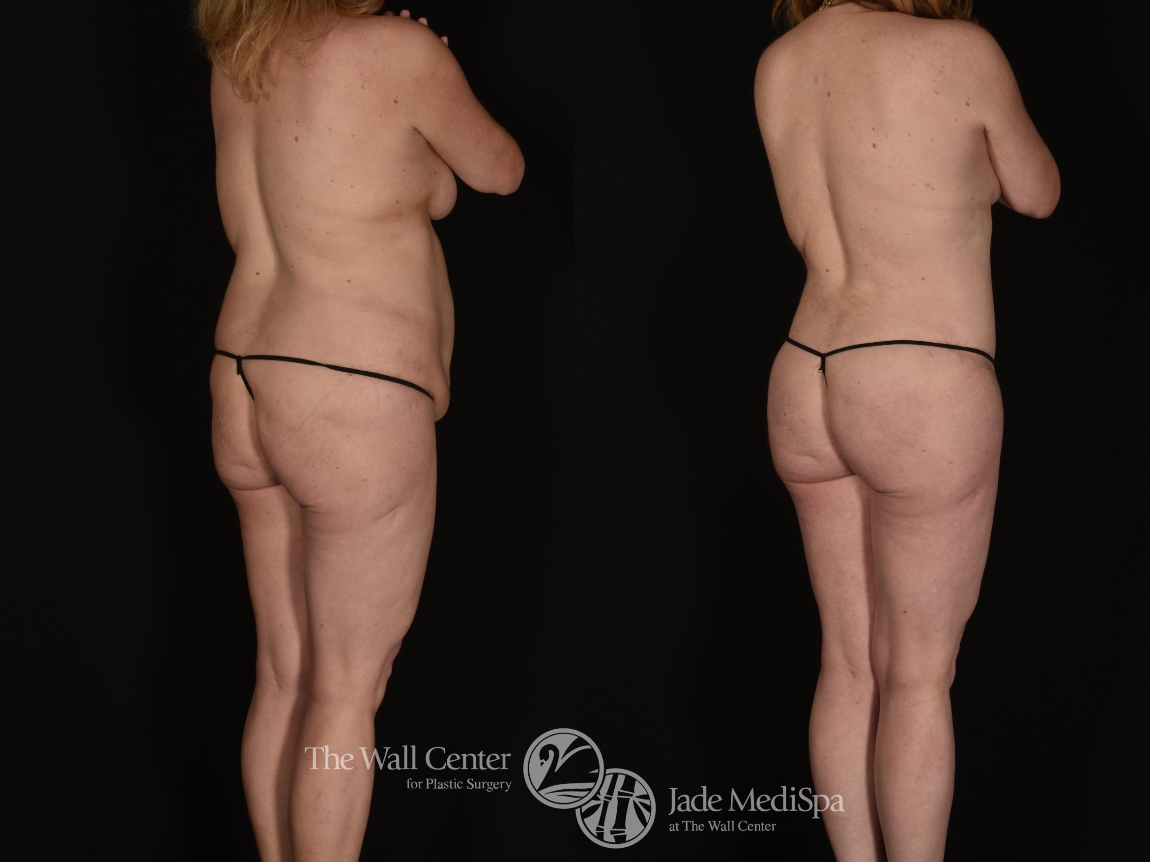 Before & After Buttock Augmentation Case 1014 Right Oblique View in Shreveport, LA