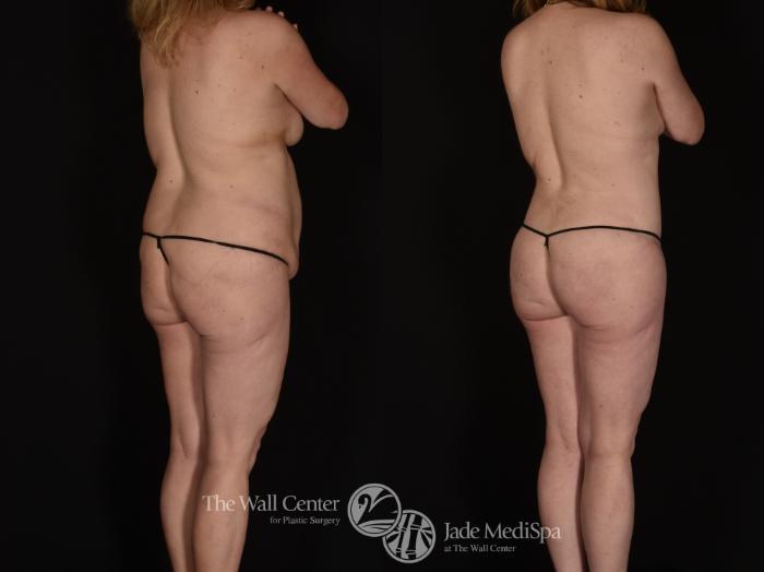 Before & After Buttock Augmentation Case 1014 Right Oblique View in Shreveport, LA