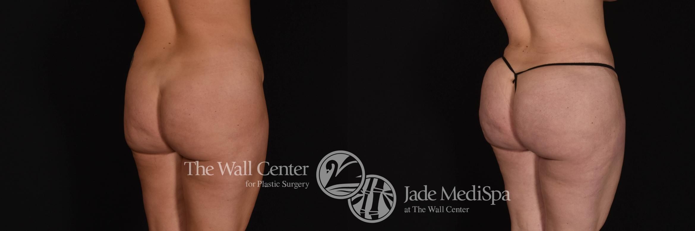 Before & After Fat Grafting – Buttocks Case 1066 Left Oblique View in Shreveport, LA