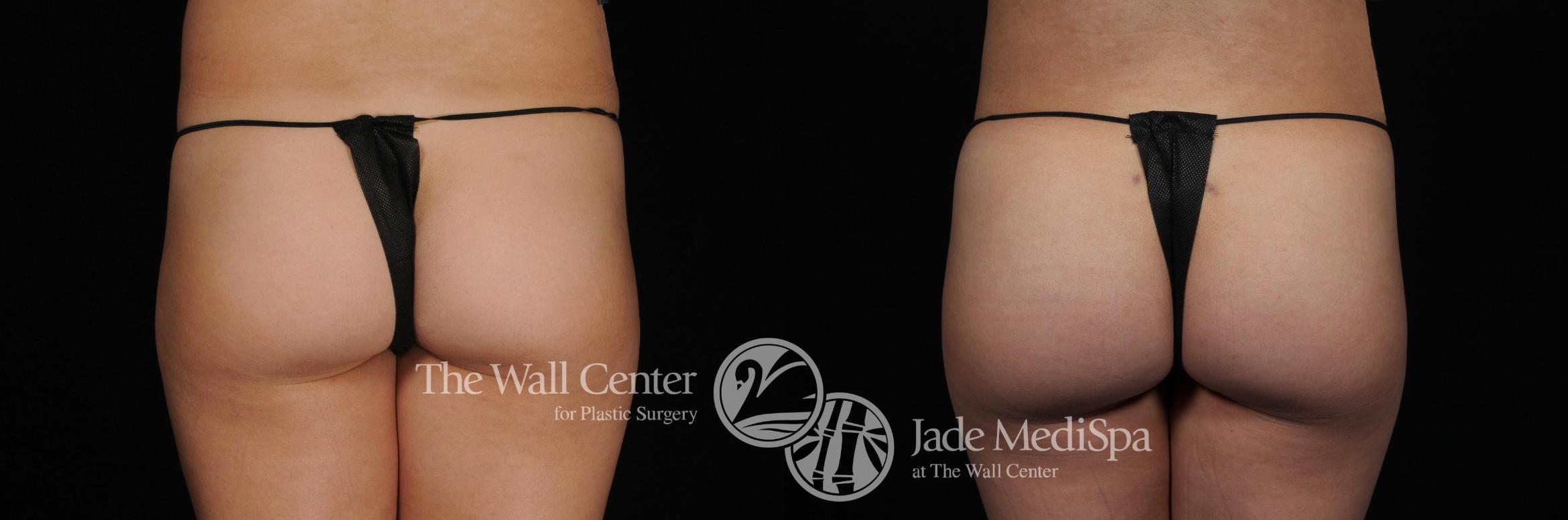 Before & After Buttock Augmentation Case 396 View #1 View in Shreveport, LA