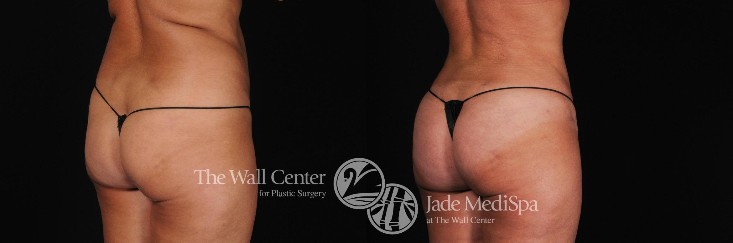 Before & After Buttock Augmentation Case 398 View #1 View in Shreveport, LA