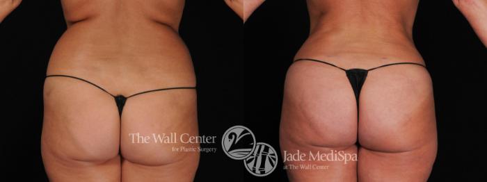 Before & After Fat Grafting – Buttocks Case 398 View #2 View in Shreveport, LA