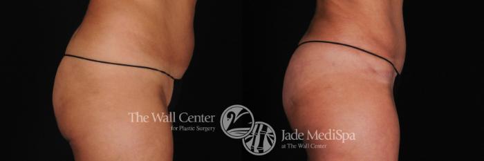 Before & After Buttock Augmentation Case 398 View #3 View in Shreveport, LA