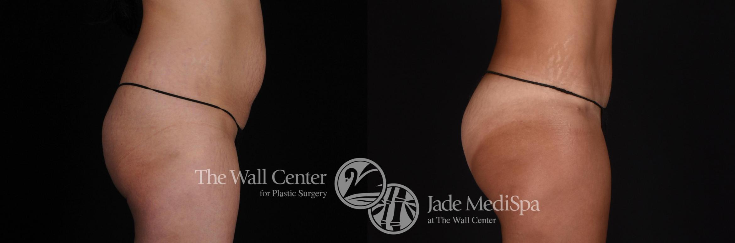 Before & After Buttock Augmentation Case 567 View #2 View in Shreveport, LA
