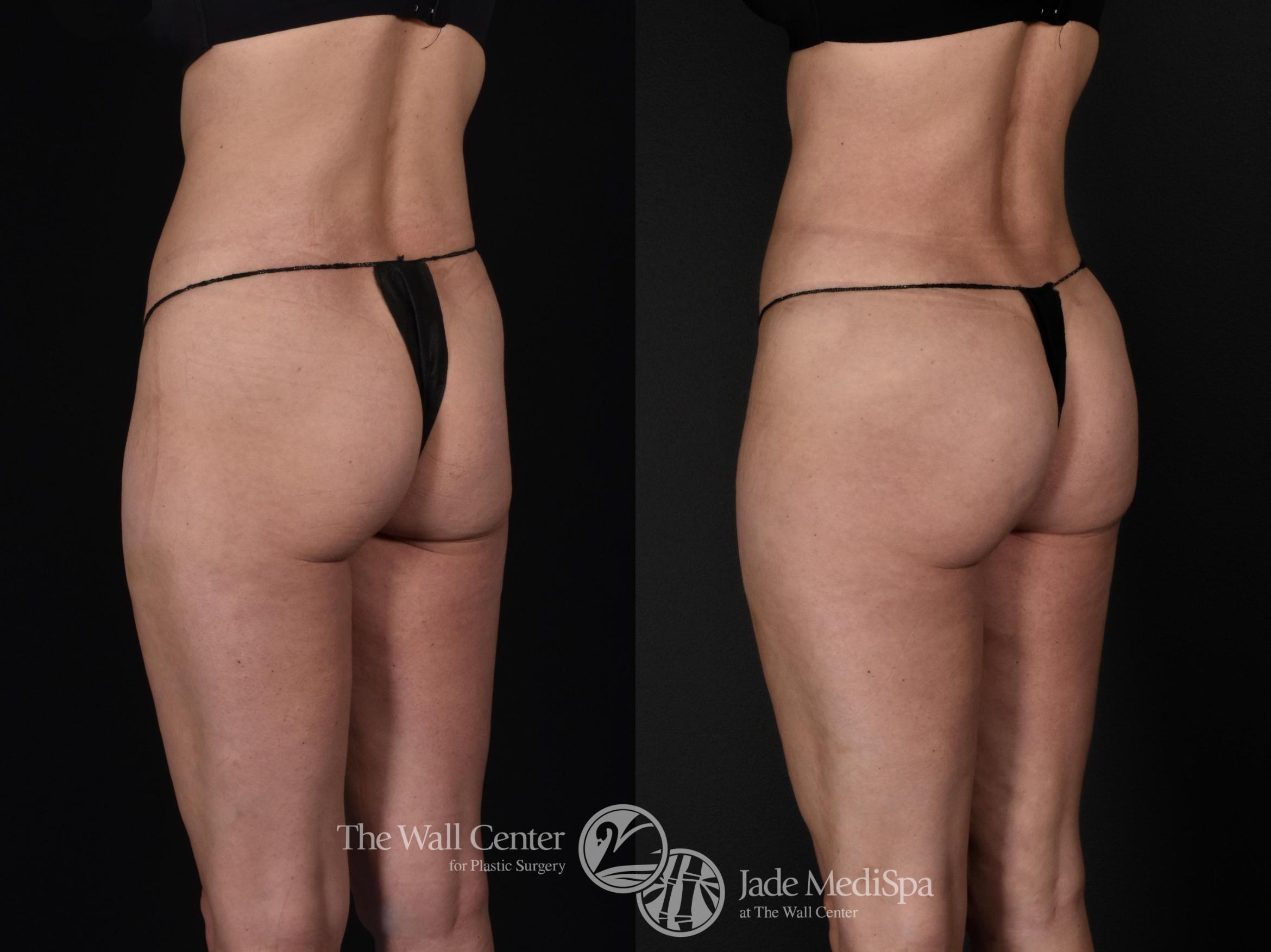 Before & After Fat Grafting – Buttocks Case 571 View #1 View in Shreveport, LA