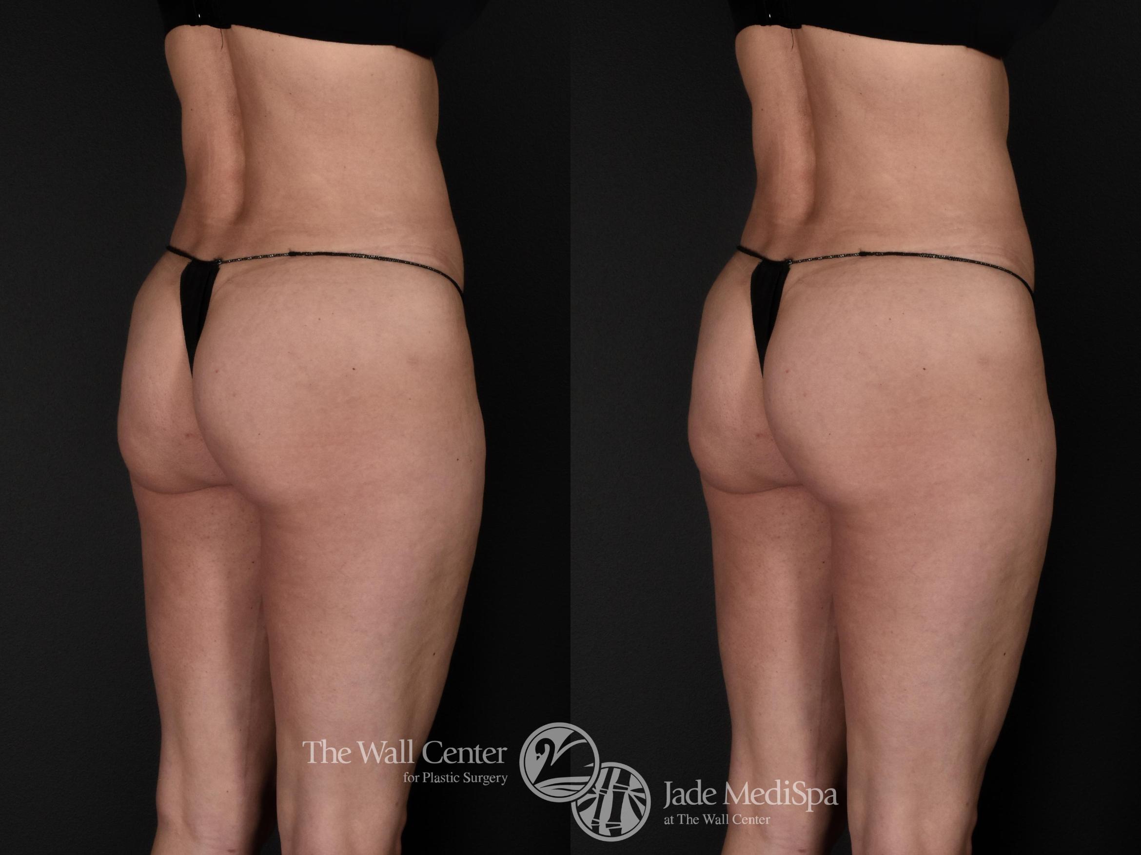Before & After Buttock Augmentation Case 571 View #2 View in Shreveport, LA