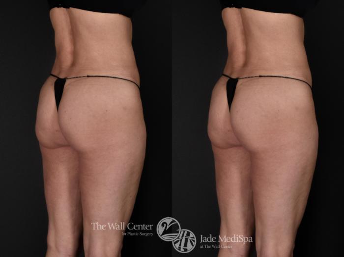 Before & After Fat Grafting – Buttocks Case 571 View #2 View in Shreveport, LA