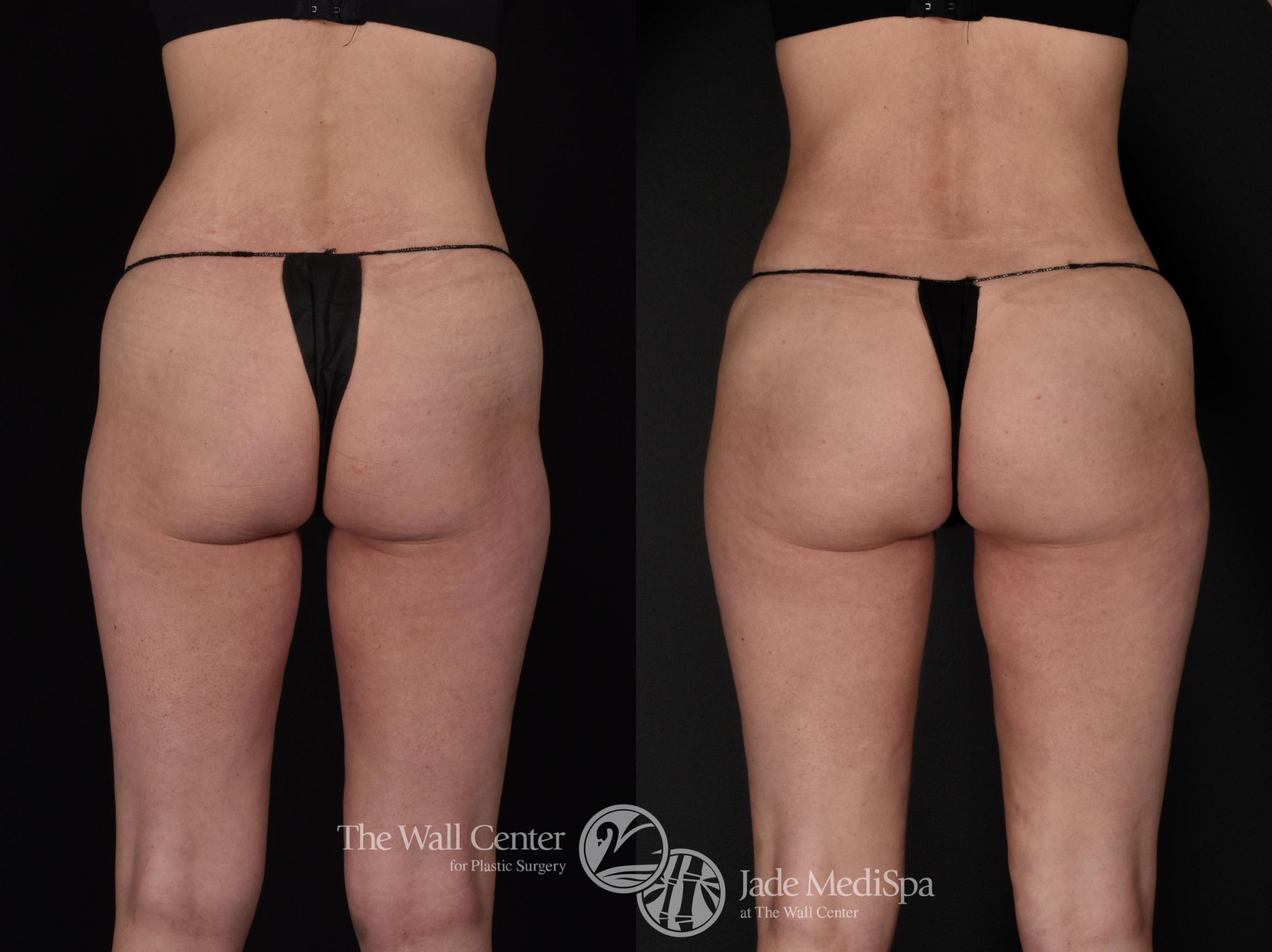 Before & After Buttock Augmentation Case 571 View #4 View in Shreveport, LA