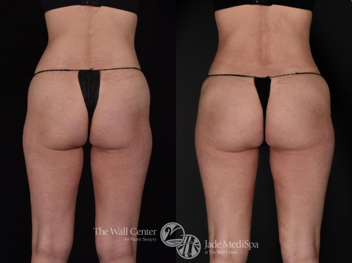 Before & After Fat Grafting – Buttocks Case 571 View #4 View in Shreveport, LA