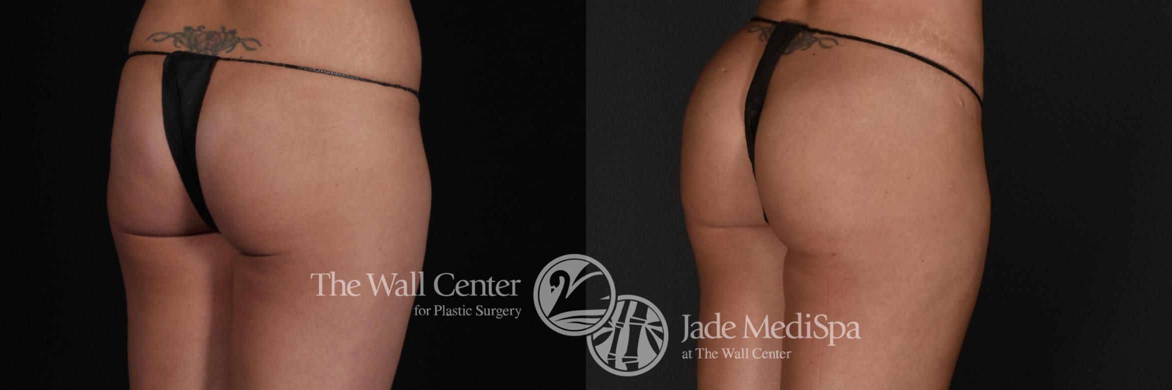 Before & After Fat Grafting – Buttocks Case 577 View #1 View in Shreveport, LA
