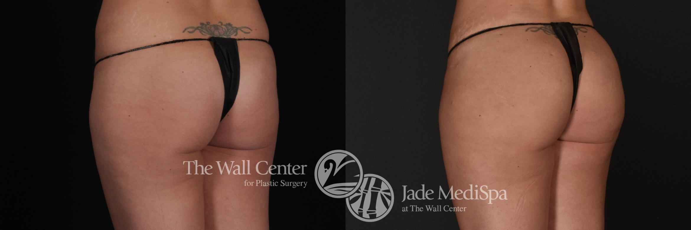 Before & After Fat Grafting – Buttocks Case 577 View #2 View in Shreveport, LA