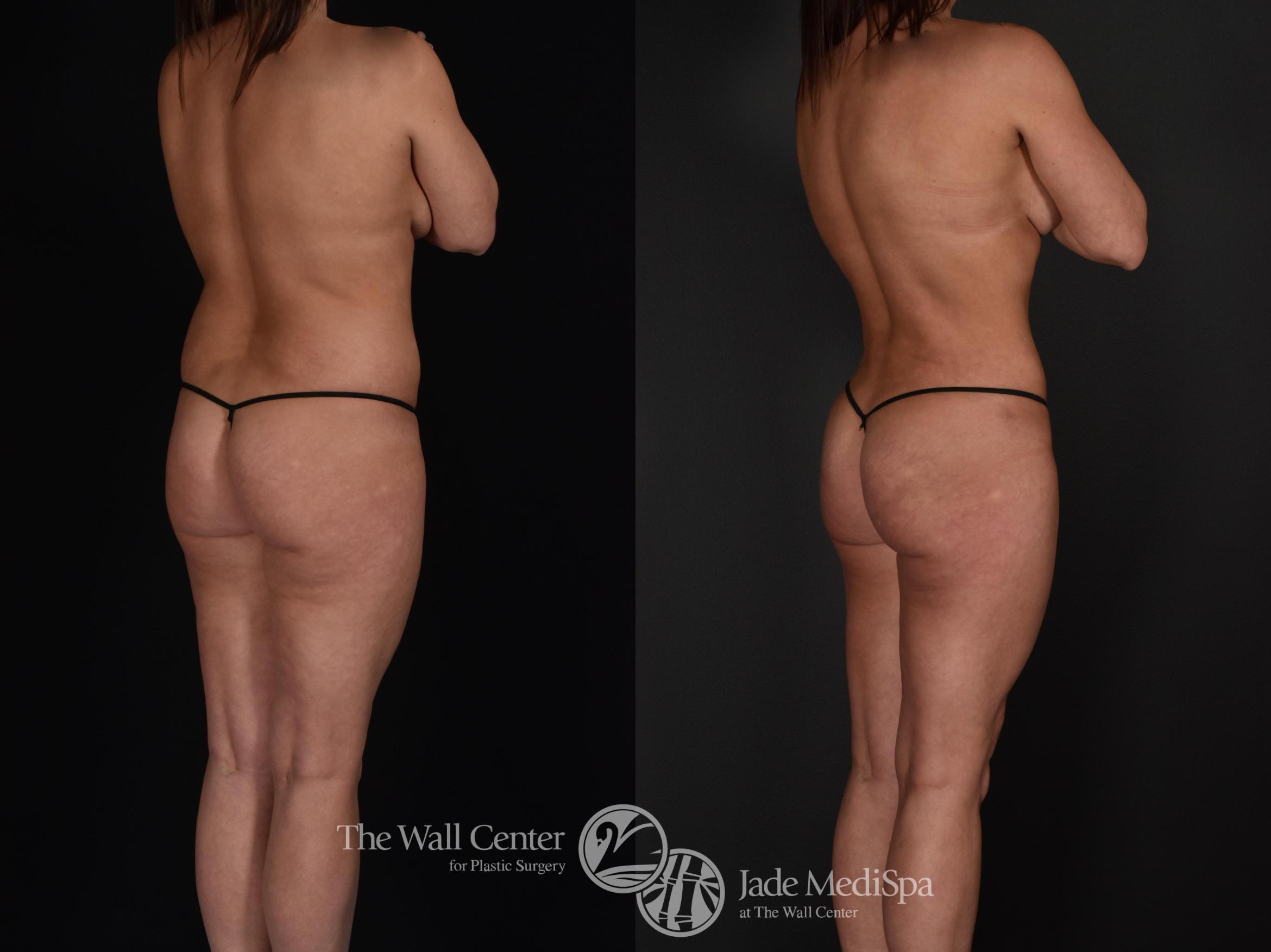 Before & After Fat Grafting – Buttocks Case 590 View #2 View in Shreveport, LA