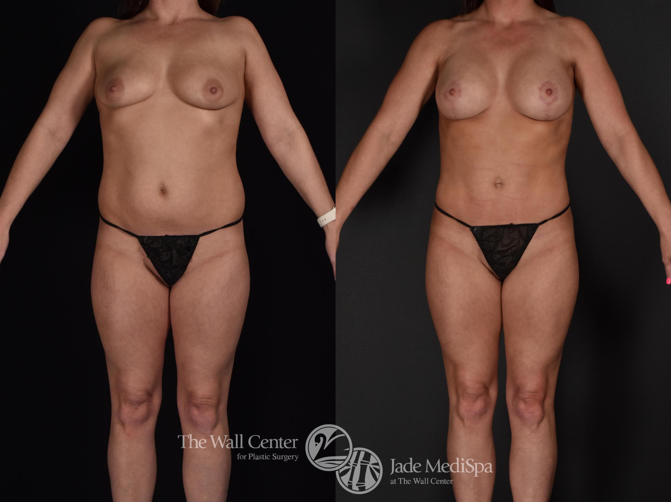 Before & After Fat Grafting – Buttocks Case 590 View #3 View in Shreveport, LA