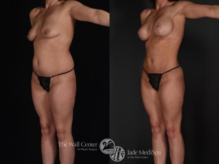 Before & After Buttock Augmentation Case 590 View #4 View in Shreveport, LA