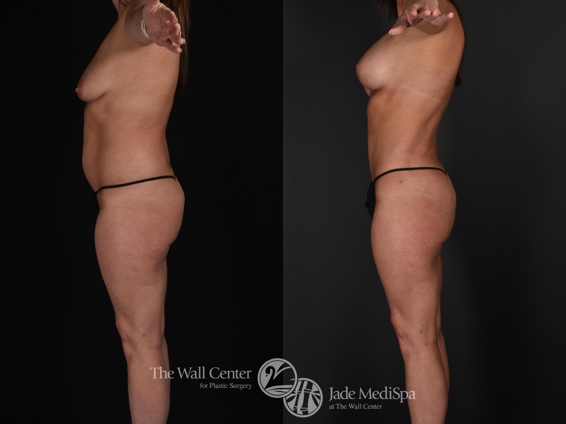 Before & After Fat Grafting – Buttocks Case 590 View #5 View in Shreveport, LA