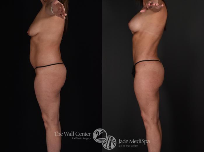 Before & After Buttock Augmentation Case 590 View #5 View in Shreveport, LA