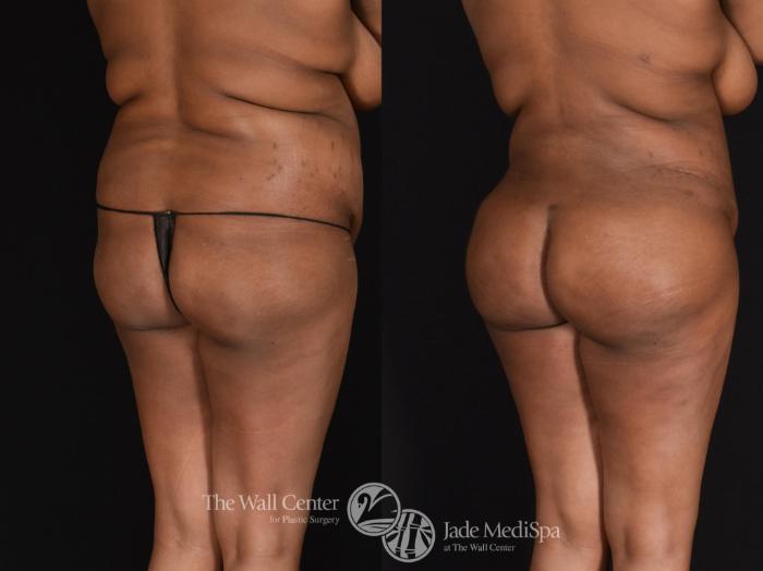 Before & After Buttock Augmentation Case 598 View #1 View in Shreveport, LA