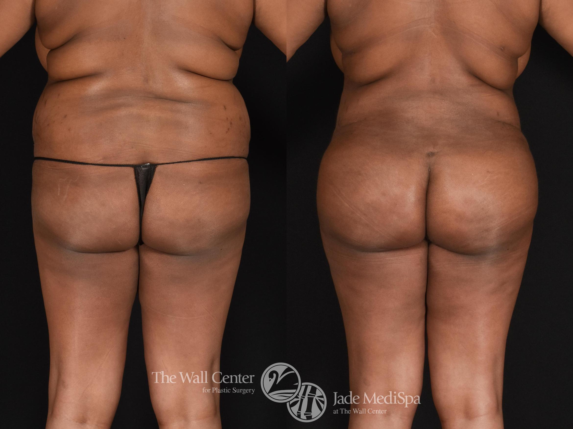 Before & After Buttock Augmentation Case 598 View #2 View in Shreveport, LA