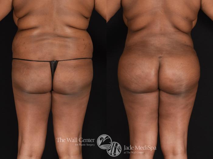 Before & After Fat Grafting – Buttocks Case 598 View #2 View in Shreveport, LA